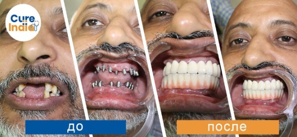 зубной имплант- Немедленная загрузка - имплантация зубов в индии